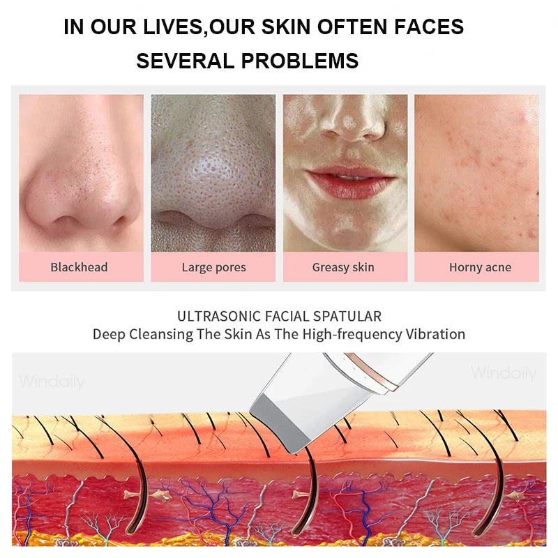 👉 ZENFORT™ Limpiador facial ultrasónico