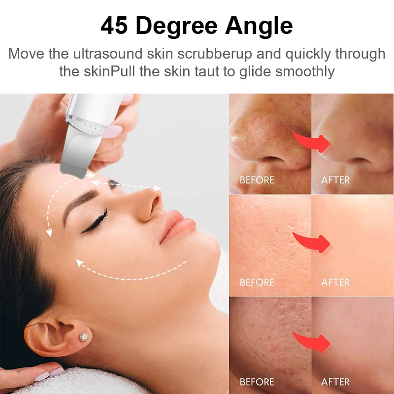 👉 ZENFORT™ Limpiador facial ultrasónico
